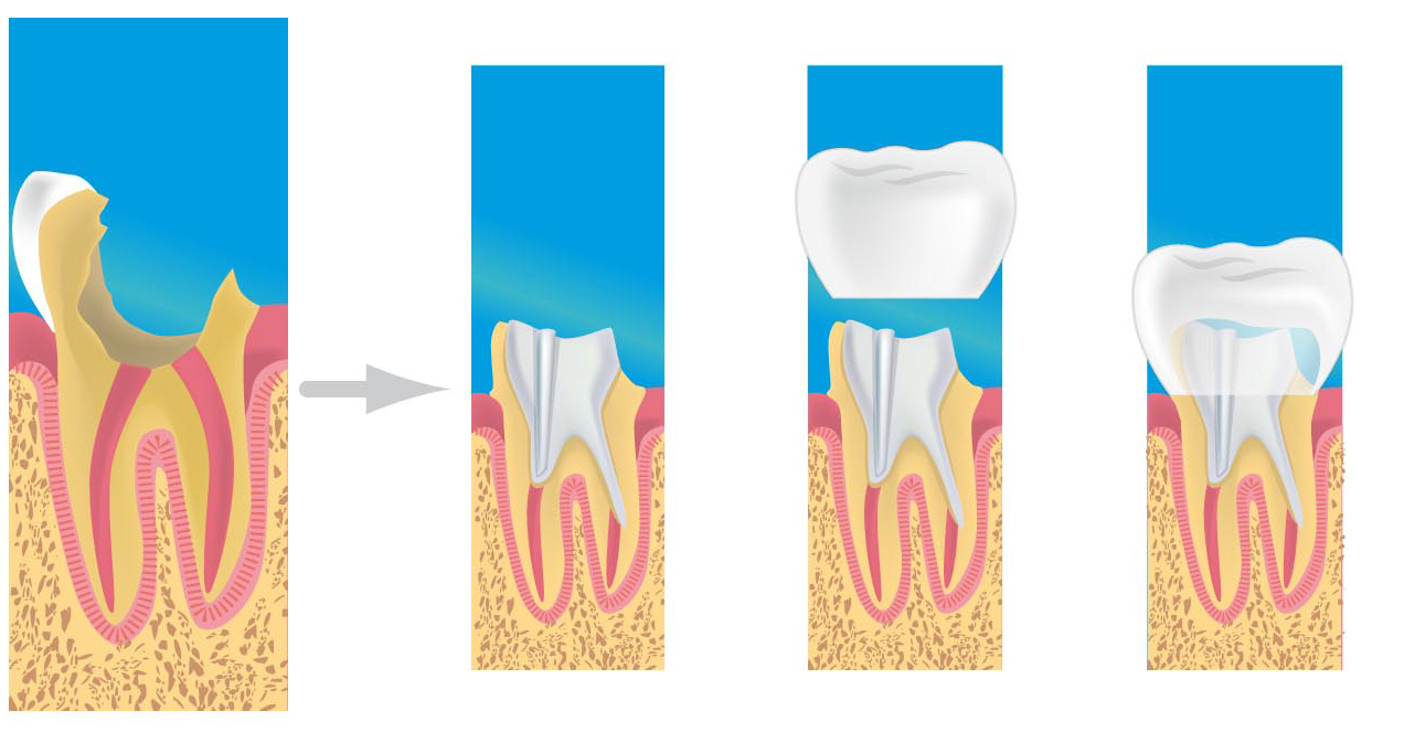 prothese dentaire par le dentiste lille